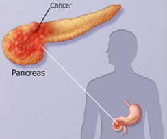 cancer-no-pancreas