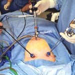 laparoscopic-surgery