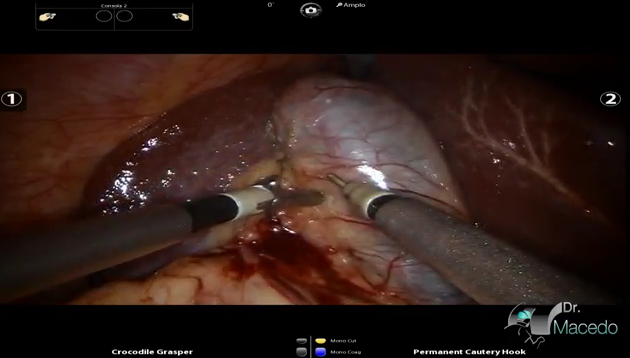 colecistectomy