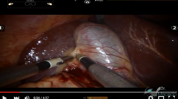 cholecystectomy