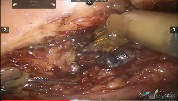 esophagectomy