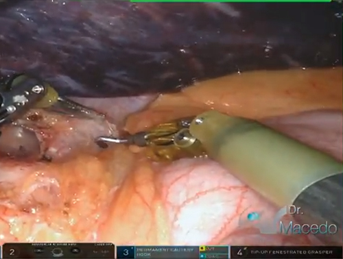 hiatalherniaxi